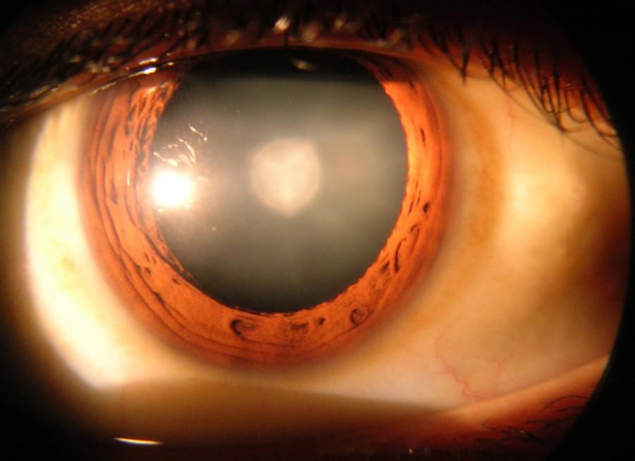 Cataract are the leading cause of vision loss in the US, and FAU researchers have made a 

discovery that can help treat cataracts without surgery. Photo courtesy of Rakesh Ahuja.